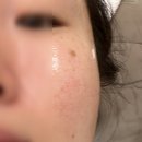 [라라필 후기]로즈시티의원 건대점 후기/ 여신티켓 이용(할인코드 유)_내돈내산