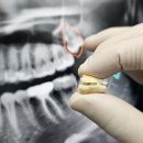 지성치과의원 | 매복 사랑니 수면마취 의식하진정법을 통한 한번에 발치 시간 통증 및 후기