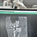 네모치과병원 | 강남 치과 고난이도 매복사랑니 발치 후기 사랑이아프니 강남점