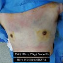 프라우드비뇨기과의원 | 여유증수술 부작용 남성 여유증 수술 비용 효과 어떨까?