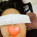 중국홍원한의원 | 안면마비 구안와사 벨마비 3번째 치료중