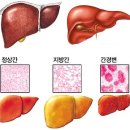 지방간(脂肪肝)의 원인과 치료법(治療法) 이미지
