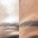 6전6회 | 노원피부관리 한의원 눈흉터 새살침 치료 6회차 후기