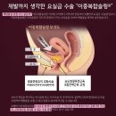 복압성 요실금 수술 진단 후 병원 선택 과정