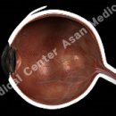 당뇨망막병증 (Diabetic Retinopathy) 이미지