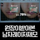 영진사우나 | 합정 피부과 남자레이저제모 후기, 면도후트러블 해결한 리얼 경험담