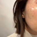 에이.비.지 | 멜라논크림 스티바에이 바르는 트레티노인 비교 해결 후기