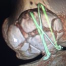의료법인 디딤의료재단 우리요양병원 | 대구 교통사고 무릎 슬개골 골절 수술-바로본병원 입원 및 수술후기