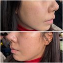 삼일사우나 | 강남역쥬베룩 손주사 효과 가격 강남피부과전문의 다녀온 후기