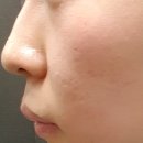 대지한의원 | 치료 전문병원추천 로담한의원 대구점 패인 흉터치료 내돈내산 한의원 피부과 새살침 치료 효과 후기(1)