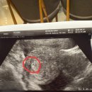 [40대 신혼부부 난임일기]시험관 신선1차/1차,2차피검,첫초음파/모태안여성병원 후기
