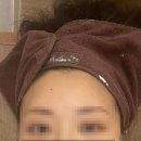 정발산약국 | [편평사마귀 제거 후기] 일산 _ 피부과 레이저 시술 대신 선택한 한의원 거우침! (Feat. 습윤밴드X)