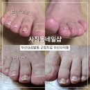 4865 | 부산 내성발톱치료 사직동네일샵 리얼후기 엄마 통증 해결!