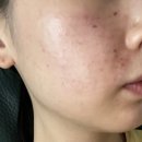 바로세움의원 | W-6. 웨딩 블로그 - 유온느 의원 통증 적은 리쥬란 힐러 후기_내돈내산