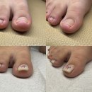 오렌지나무의원 | 대전내성발톱 지긋지긋한 내성발톱 케어로 해결