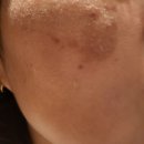 천안한의원 | 천안 여드름 흉터 전문한의원 2회차 내돈내산 후기