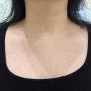 목주름 필러 후기 - 강남 넥케어, 벨르넥 가격 및 1차 솔직 상세 후기