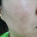 차한의원 | 천안 여드름 흉터 전문한의원 12회차 내돈내산 후기