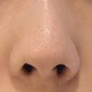 셀리핏 | 분당모공관리 트라이엄 포어핏 솔직후기 (전후비교사진있음)