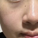 본촌초등학교 | 광주 본촌동 더뷰티라인 재방문 하드론젝션 후기