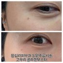 구립왕십리하나어린이집 | 왕십리피부과 눈밑주름시술 후기 고우리 콜라겐 부스터 + 고주파레이저 효과 및 가격