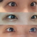 빨리 | 눈밑지방재배치 멍 눈 붓기 빨리 빼는법! 회복과정 솔직 후기