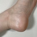 왼쪽 발뒤꿈치통증 원인, 자가치료 여정 후기(족저근막염)