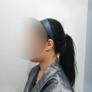 [지방분해주사 플라덴 뽑기주사] 시술 직후, 일주일 후 변화