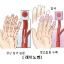 레이노병 (Raynaud`s Phenomenon) 이미지