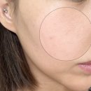 더탐나홈케어 | 강남역 포텐자 모공 레이저 효과 좋았던 피부과 시술 통증 가격 후기