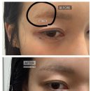 브로우라운지 | 청주 눈썹문신 잔흔제거 :: 브로우라운지 리얼후기