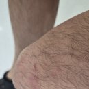 우리대학약국 | 동해안 회센터 털게 먹고 알러지? 두드러기로 대학병원 응급실 다녀온 후기