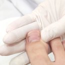 부평 간석동 내성 발톱 무좀 전문 김수정 뷰티