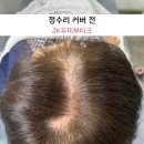 제이케이(JK) 유도클럽 | 흑채로 인한 탈모 한 달만에 종결 (광주두피케어전문 JK두피부띠크 고객님의 진짜 후기)