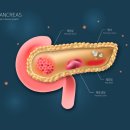 5년 생존율 최저 수준… 여전히 지독한 '이 암' 이미지