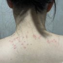 새시민약국 | 편평사마귀 목 얼굴 제거 후기 첫날부터 2주차까지 경과 기록