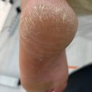 조은발관리샵 | 우두두 떨어지는 남편 발각질 관리 안산 전문샵 후기