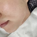 땅콩짐 | 압구정피부과 땅콩형얼굴이 티타늄리프팅 60KJ 받아본 내돈내산 솔직 후기