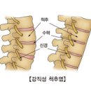 강직성 척추염 (Ankylosing Spondylitis) 이미지