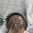 하정훈 소아과 진료 후기, 사두증, 습진, rsv바이러스 접종