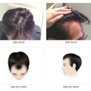 수원-2056 | 수원탈모두피관리는 닥터모다르 수원점