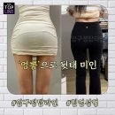 엉뽕 만드는 힙업성형! 지방이식후기 추천｜압구정탑라인의원