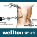 무릎'뚝'소리나면서 통증발생, 전방십자인대파열 어떻게 치료할까요? 이미지