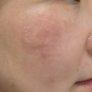 내자약국 | [서울 / 마포구] 홍대 피부과 리팟레이저 흑자 제거 후기. 리팟 레이저 시술 후 주의사항 및 관리방법