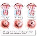자궁질환의 대표적인 질환 자궁경부암 이미지