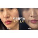 분당 피부과 피코줌패스 색소침착 딱지 기미 잡티 레이저 제거 피코토닝 후기