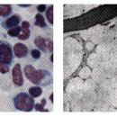 재생불량성 빈혈(Aplastic anemia) 이미지