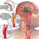 뇌경색(腦梗塞Cerebral Infarction), 허혈성 뇌졸중(Ischemic Brain Stroke) 이미지