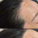 수헤어라인 이미지