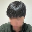 닥터올린의원 | [시술 1일차_용닥터모발의원 모발이식 후기]_ 2,500모 비절개 헤어라인